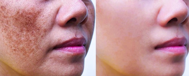 melasma