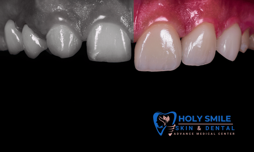 smile designing by Dr Amit Nandi at Holysmile kolkata