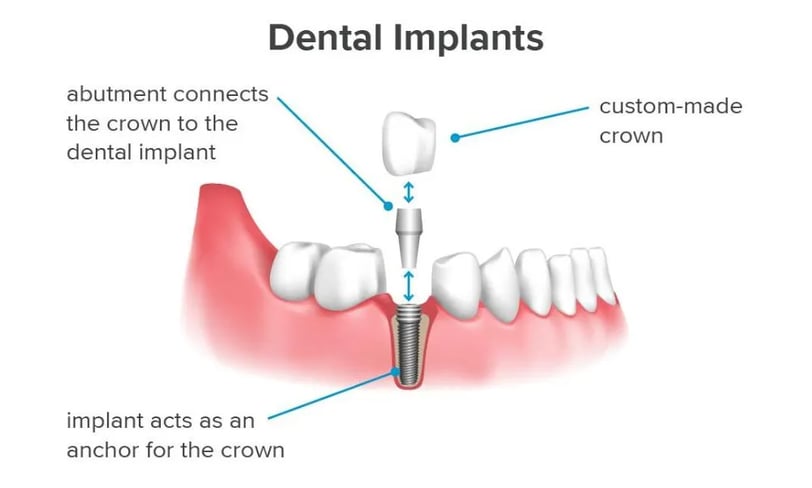 dental implant kolkata sealdah