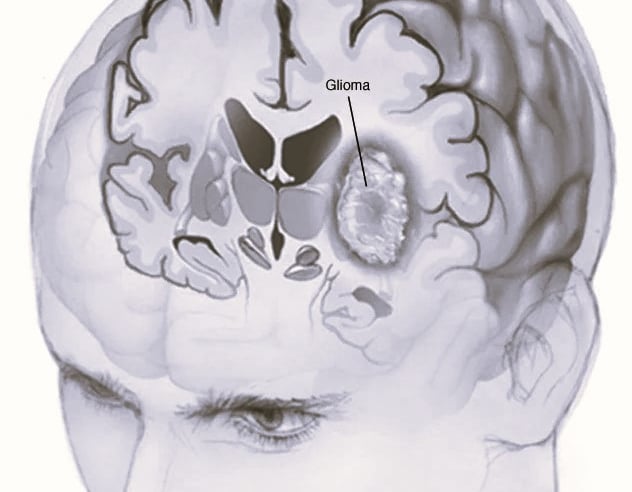 Glioma
