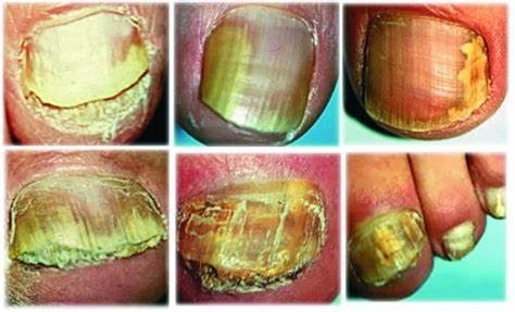 Onicomicosis
