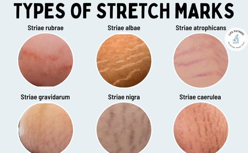 Stretch mark