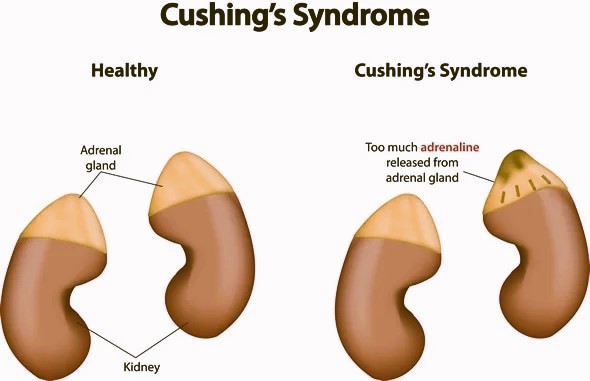 Cushing Syndrome