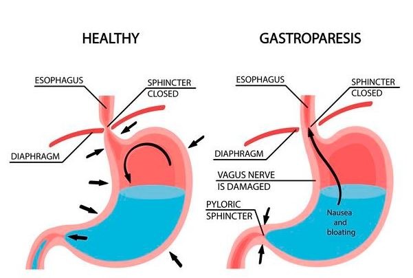 understanding gastroparesis