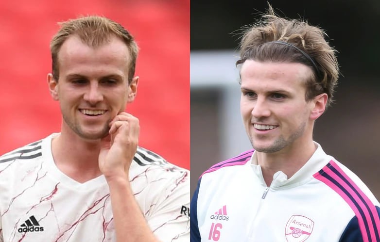 Rob Holding hair transplant