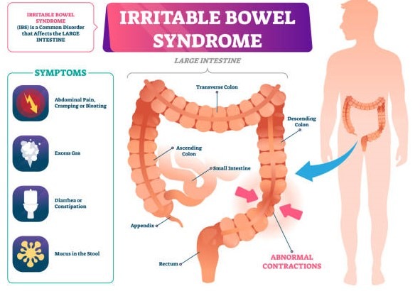 irritable bowel syndrome