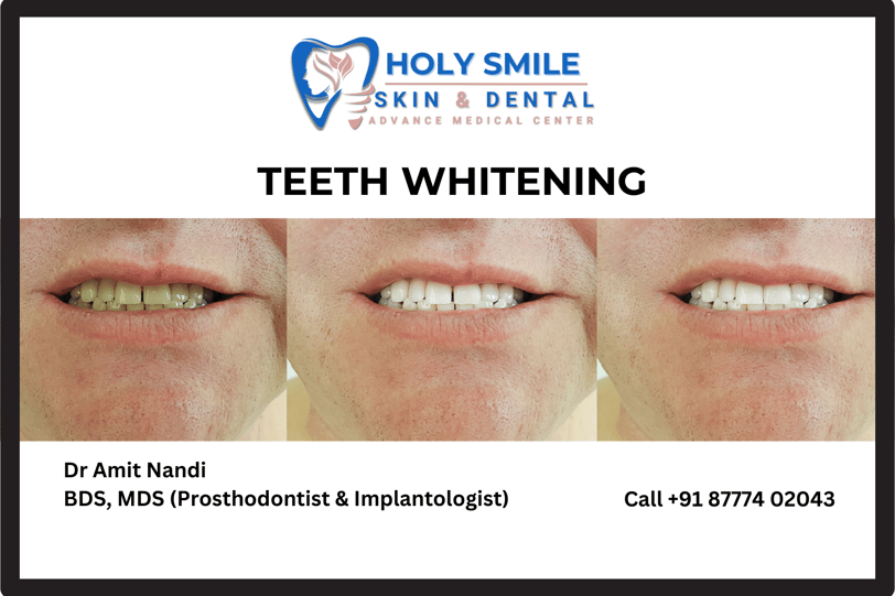 teeth whitening treatment at holysmile dental clinic kolkata