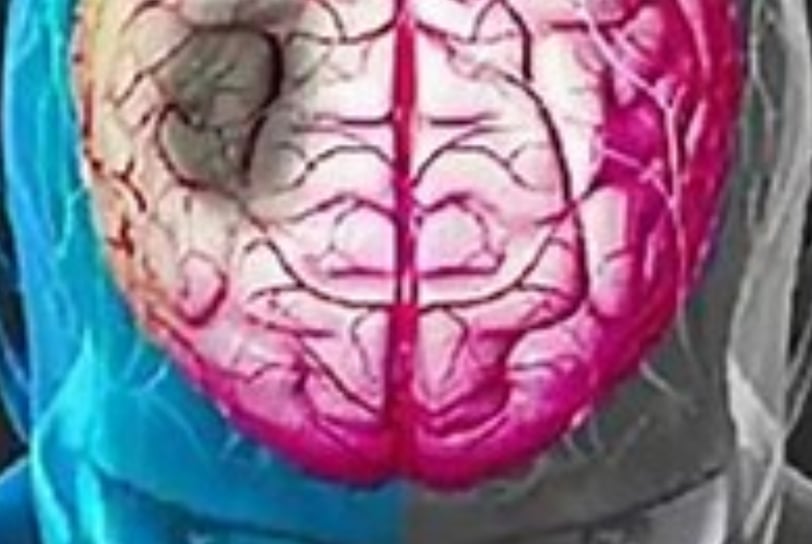 what is the best Post-stroke-stroke management