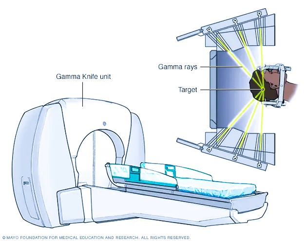 stereotactic radiosurgery