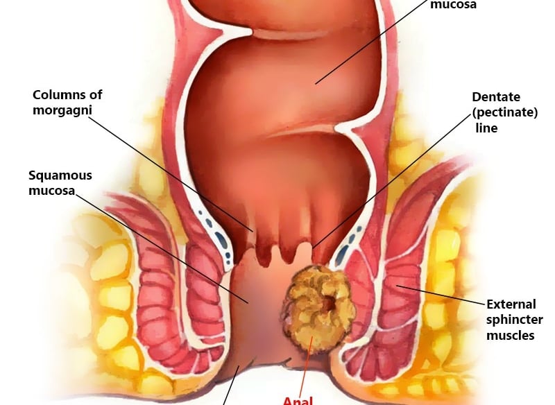 anal cancer