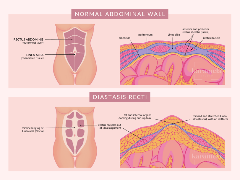 Diagram: Normal Abdominal Wall and Diastasis Recti