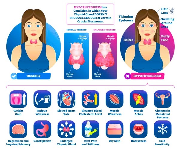 Hypothyroidism