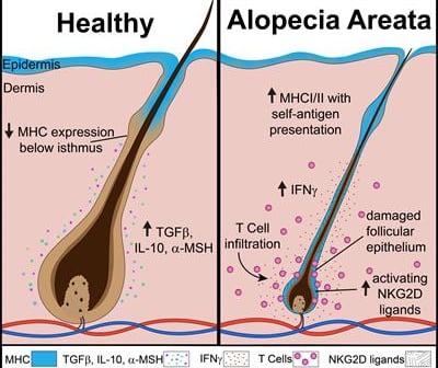 alopecia areata