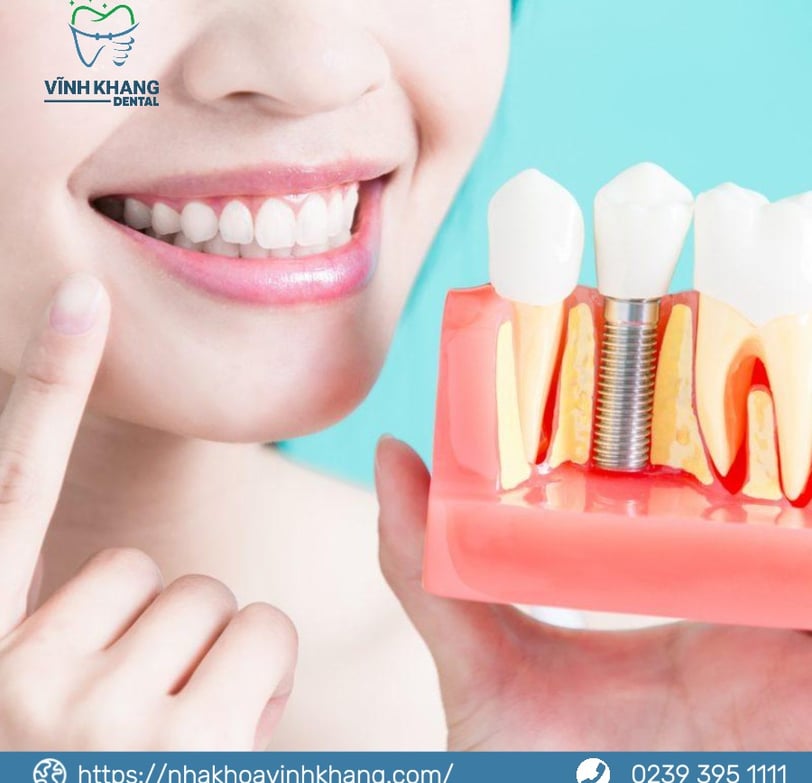 trồng răng Implant