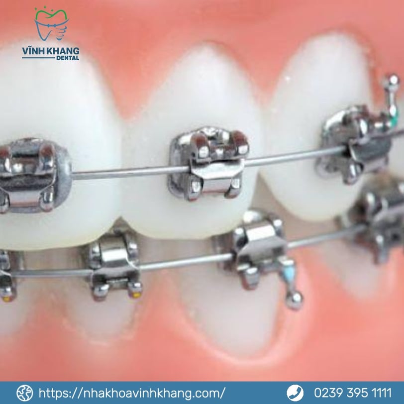 Mắc cài tự khóa