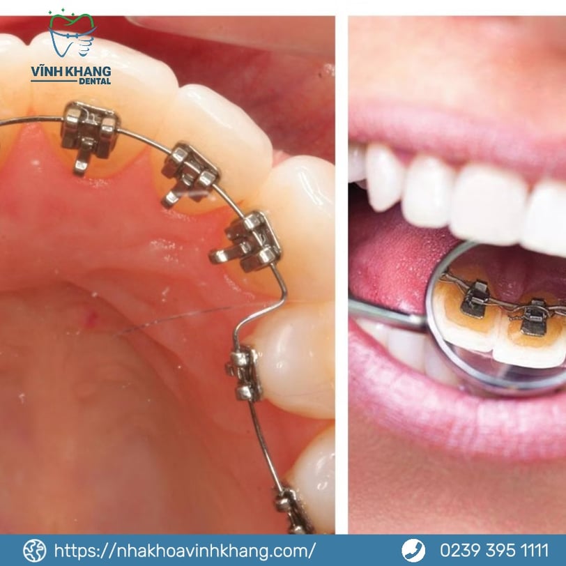 Mắc cài mặt lưỡi