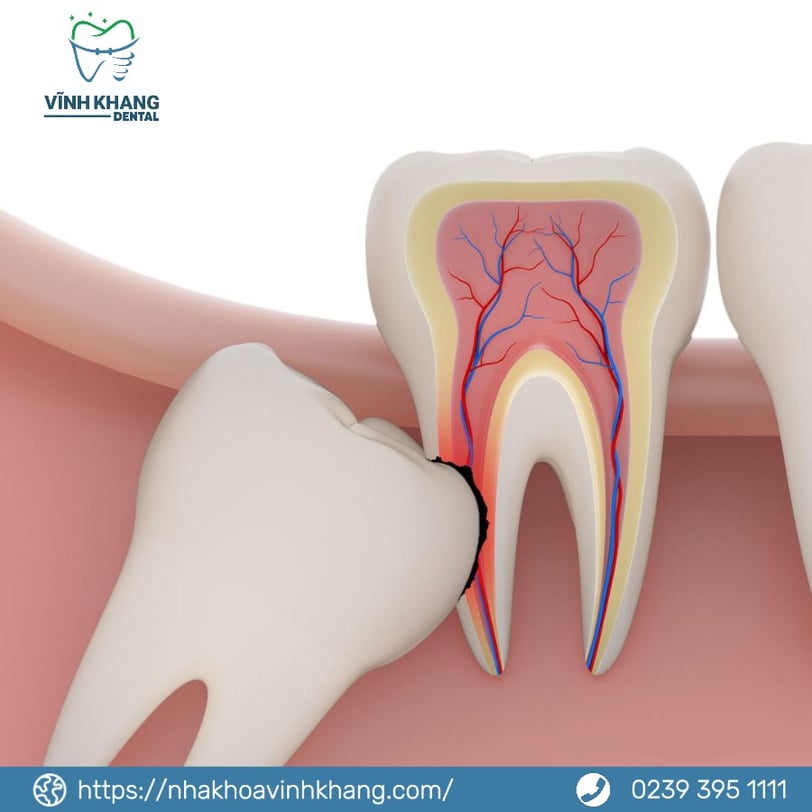 Những Lý Do Chính Để Nhổ Răng Khôn