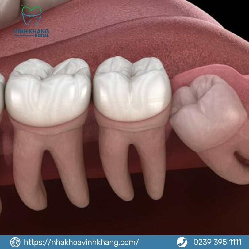 Những Lý Do Chính Để Nhổ Răng Khôn