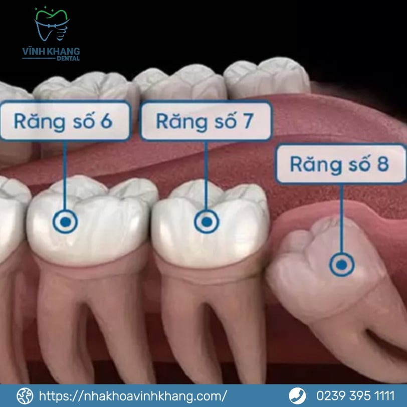 Những Lý Do Chính Để Nhổ Răng Khôn