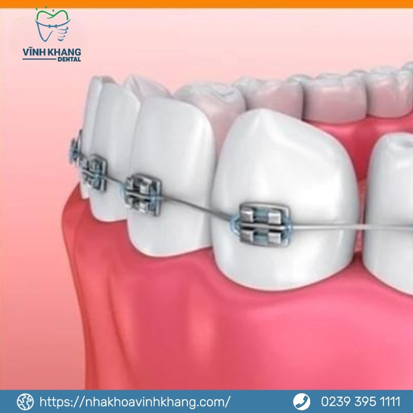 Mắc cài tự động và mắc cài buộc chun có cấu tạo và chức năng gì?