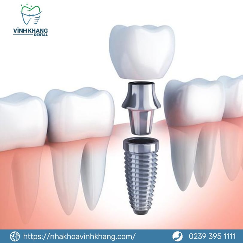 trồng răng Implant