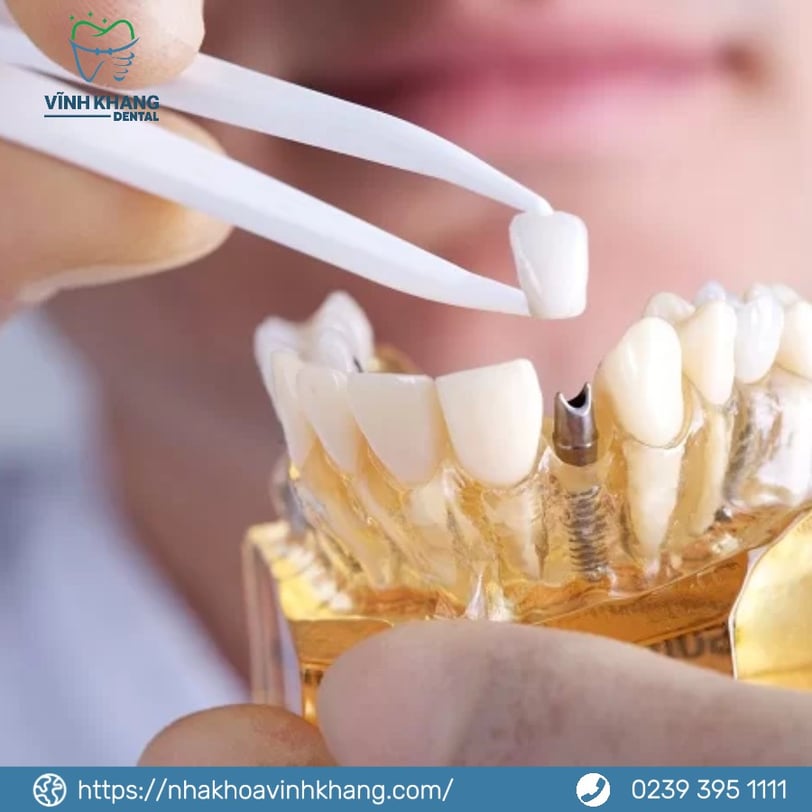trồng răng Implant