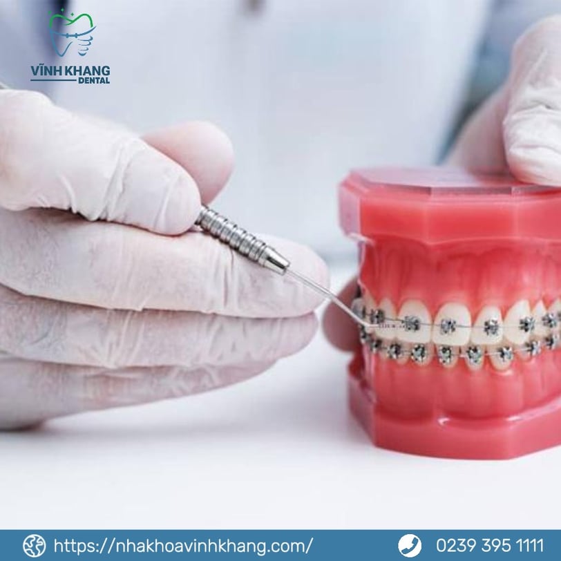 Ưu – nhược điểm của các loại mắc cài niềng răng
