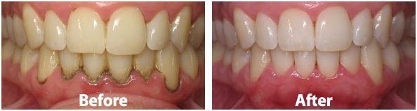 scaling and polishing in baner