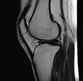 Knee MRI