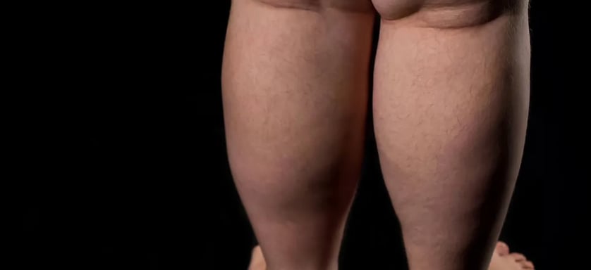 lipedema