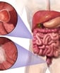 Imagen de Cáncer de Colon utilizado en la pagina web de la Dra. Arlenis Guzmán 