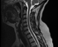 Spine MRI