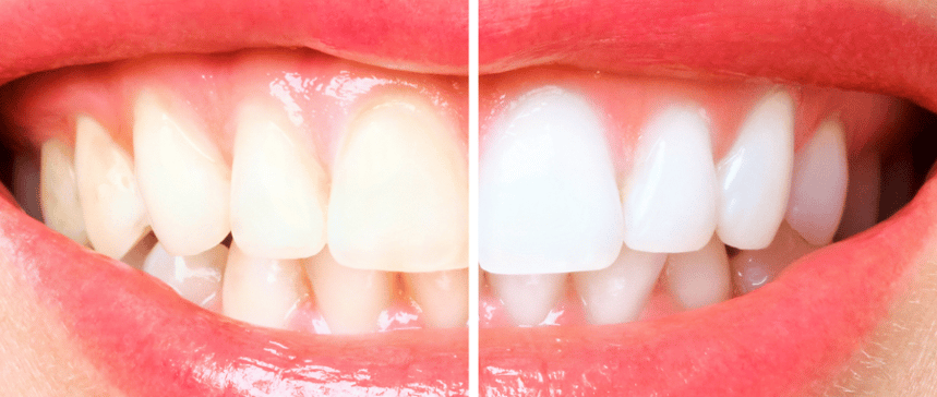 A bright and healthy smile achieved through professional tips from teeth whitening dentist