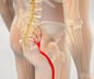 Sciatica