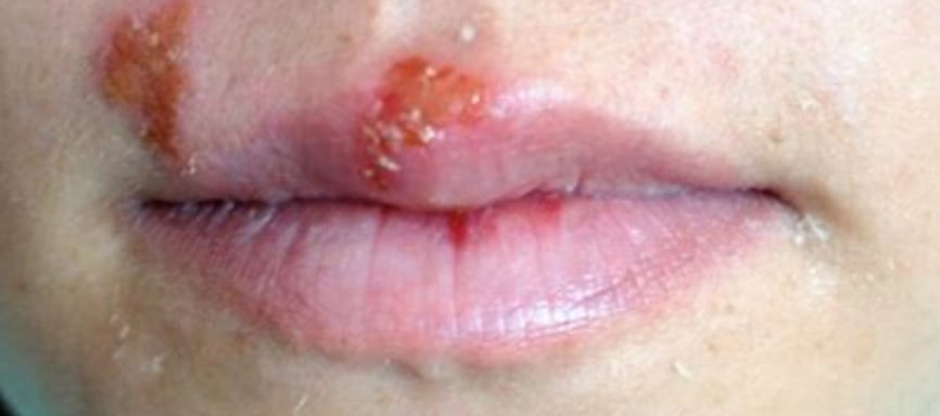 herpes simplex