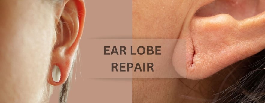 ray and rio's speciality Ear Lobe Repair: Restoring Confidence and Bringing Back Your Earring Dreams