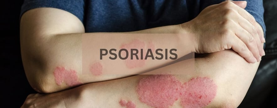 psoriasis treatment in chennai