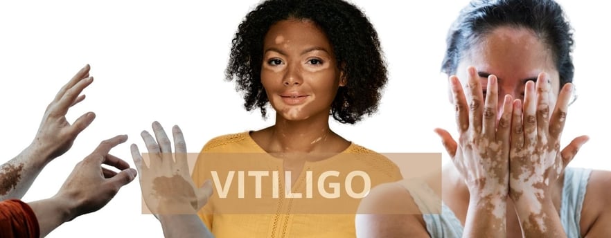 ray and rio's speciality clinic Vitiligo treatment
