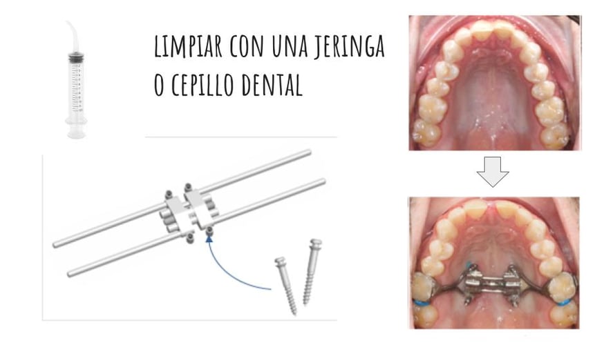 limpieza del expansor maxilar mse