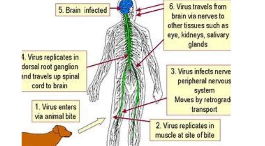 brain infection