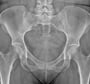 Pelvis Xray