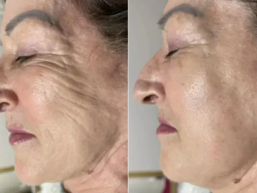 Resultado real do tratamento Ultraformer — pele firme e contornada