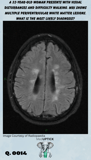 brain CT scan with multiple periventricular white matter lesion