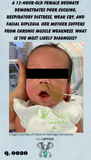 a female neonate with facial diplegia