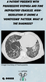 a CT scan demonstrating a 'honeycomb' lung pattern