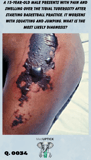 skin necrosis on a patient's leg