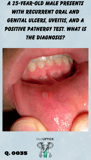 a close-up of an oral ulcer