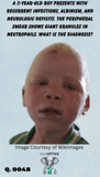 a young African American boy with albinism