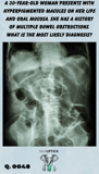an abdominal x-ray demonstrating bowel obstruction