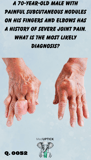 a close up of an elderly patients hands with disfigurement and joint masses